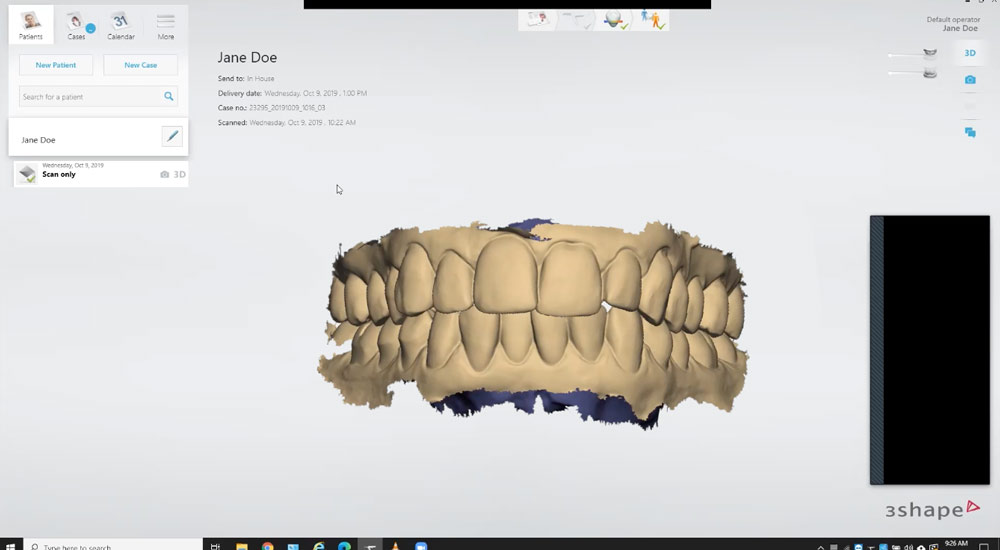 STL from Intraoral scanner